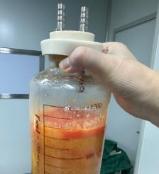 浮梁水动力吸脂手术要做多久？